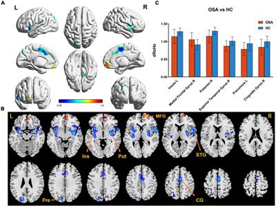 Dynamic regional homogeneity alterations and cognitive impairment in patients with moderate and severe obstructive sleep apnea